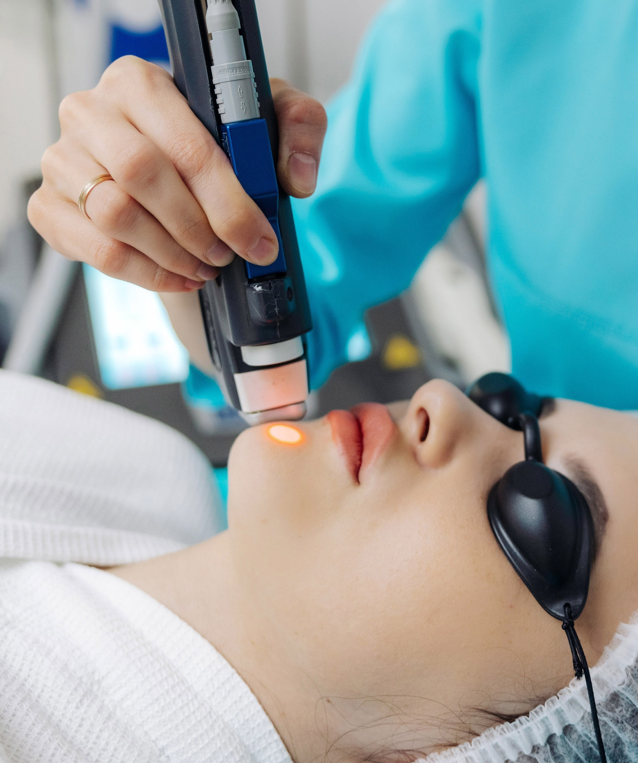 Лазерное лечение SYNCHRO FT: точное решение для пигментации, сосудов и акне в Иркутске